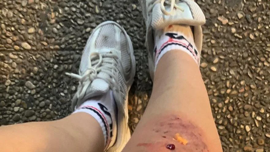 PERRO MORDEDURA PIERNA