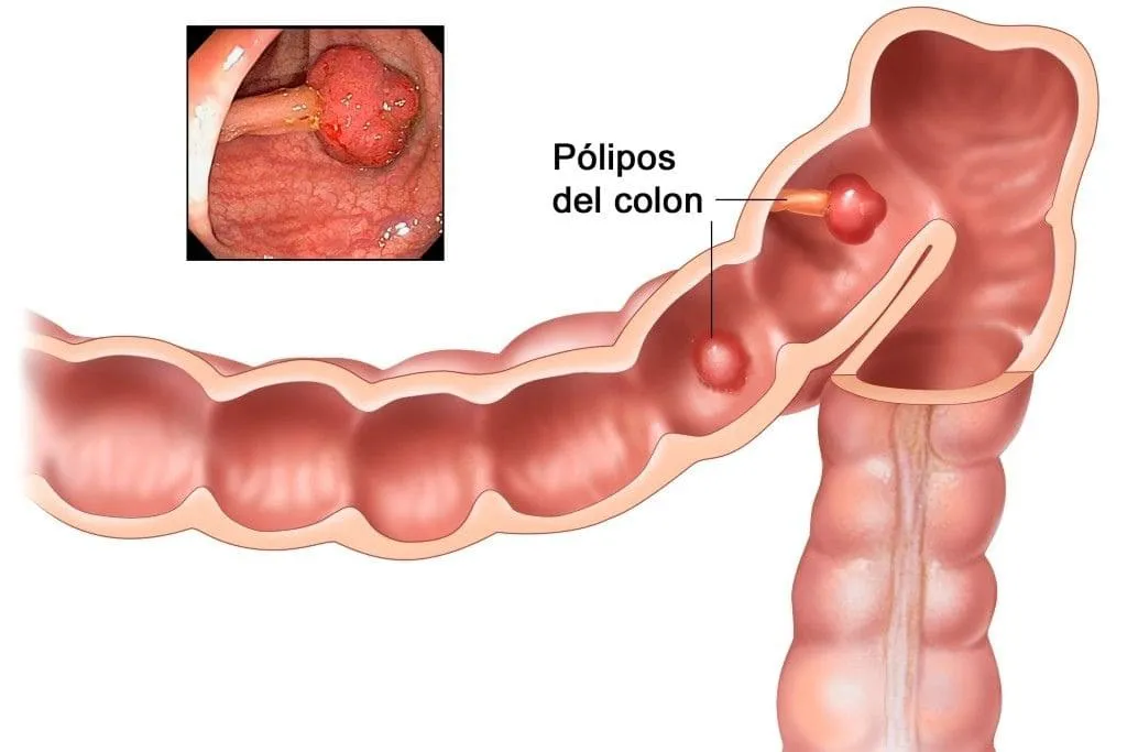 cancer-de-colon