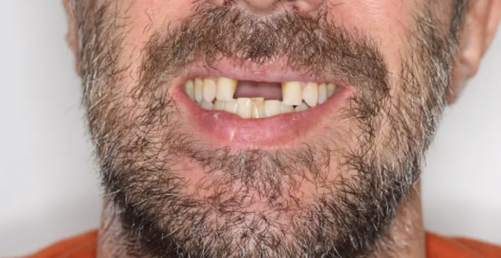DIENTES